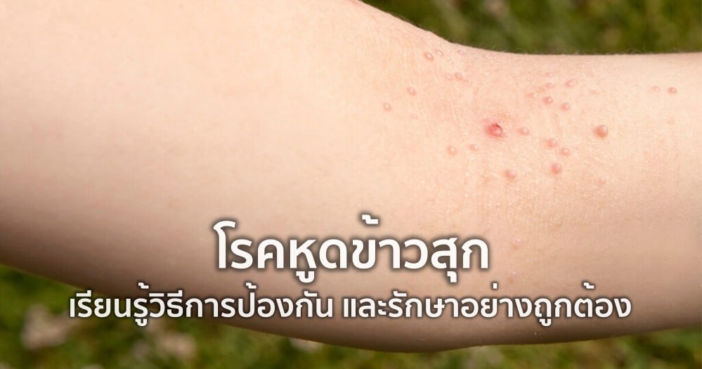 หูดข้าวสุก: อาการ การติดต่อ การรักษา และการป้องกัน